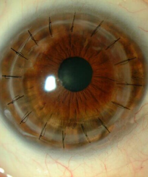 trasplante-cornea-768x512